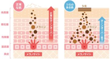 シミができるメカニズム