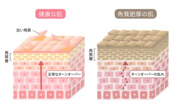 角質肥厚による肌トラブル