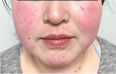 タイプ別！赤ら顔の原因と治療法 | 【公式】肌能力回復フェイシャルスタイリストサロンの画像